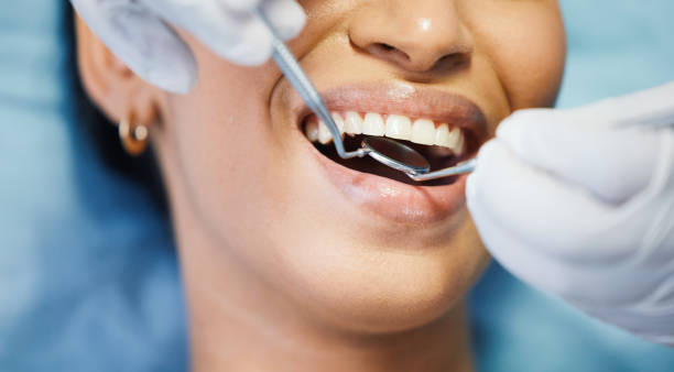 Best Emergency Dental Care for Broken or Chipped Teeth in East Pasadena, CA